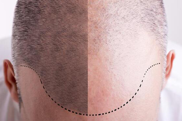 DHI SAÇ EKİMİNİN AVANTAJLARI 