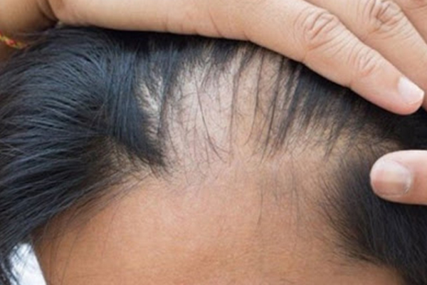 Dhı/Fue Sakal Ekimindeki Sonuç ve İyileşme Süresi Ne kadardır?